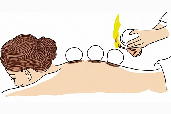 中医拔罐,拔罐误区,拔罐正确操作,pg电子官方网站 中医拔罐,拔罐误区,拔罐正确操作,pg电子官方网站