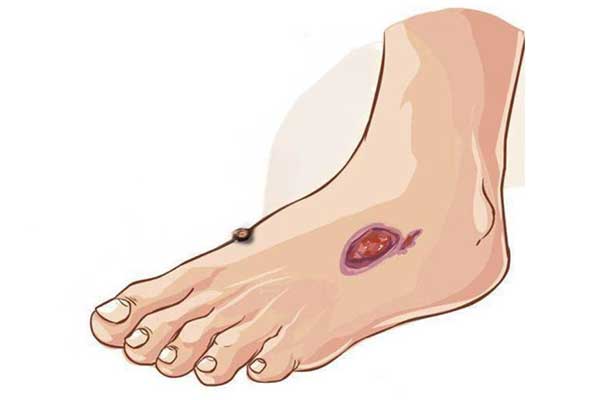 糖尿病足,糖尿病足高危人群,日常防护,就医信号 糖尿病足,糖尿病足高危人群,日常防护,就医信号